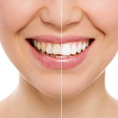 image thumbnail for Teeth Whitening